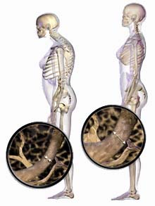 cairnschiropractor-osteoporosis