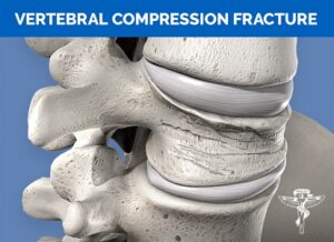 compression fracture